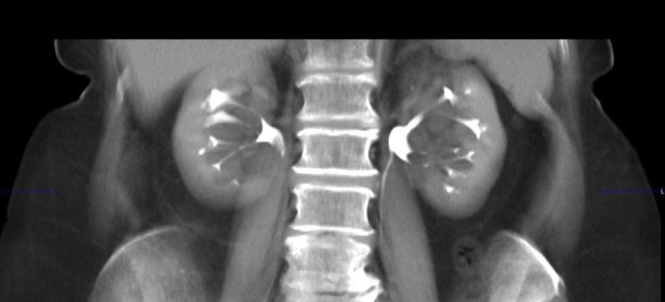 the cystic spaces communicate? Are the walls convex? Is there a renal pelvis?