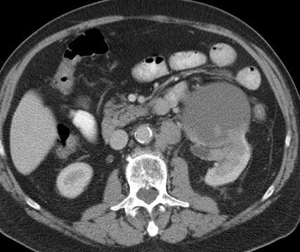 Evaluate cysts carefully Cystic RCC (Bosniak Category IV) Lymph node metastases Cysts showing more than