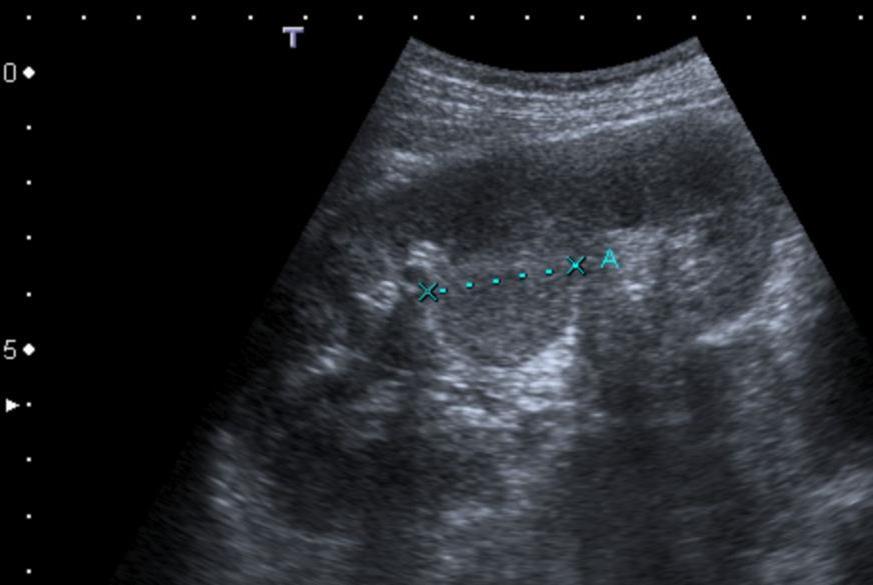 Junction of upper and middle third Isoechoic (occasionally echogenic) Smooth renal contour Pyramid