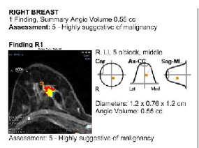 Problem Solving MRI to assess screen detected abnormality right breast original mammographic lesion appeared to be