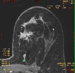 Lobular carcinoma Mass or