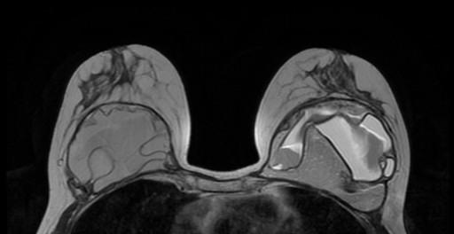 Implants MRI is indicated for problem solving focal abnormalities where triple assessment has failed to