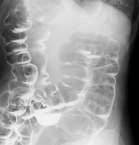 Large bowel III Double contrast barium enema Selected cases only, excellent mucosal detail Single contrast enema