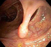 below lower esophagus) >2cm Exophytic (into lumen) may bleed and