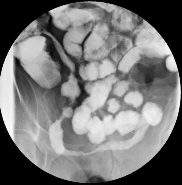 Small bowel Iatrogenic Adhesions Obstruction Inflammatory Crohns Ulcers & strictures Vascular Ischaemia from SMA Oedema, pneumatosis