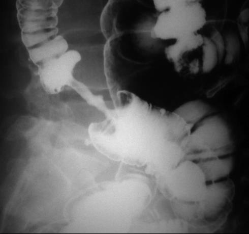 Large bowel Neoplastic Adenoca Mass, obstruction Inflammatory UC Psudopolyps,