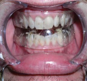 Fig. 3. EMA, open anterior. Fig. 5. The Moses Appliance a mandibular advancement device that facilitates tongue protrusion. study by Puhan, Suarez et al.