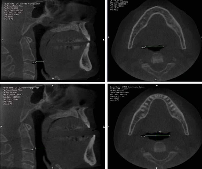 Fig. 9. Cone beam CT scans. First two radiographs across show the patient at rest position, tongue in roof of mouth and no appliance.