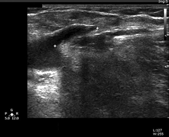 (B) Six months after ablation of small saphenous vein: a color Doppler image was used for measurement due to relatively deep position of vein. The distance was measured as 0.802 cm.