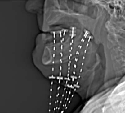 Brachytherapy Traditionally BT implant has been