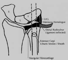 -EFFUSION (fluid within DRUJ can be normal) -INTRAOSSEOUS GANGLION (RADIAL ASPECT OF LUNATE) may enhance esp if not contiguous with