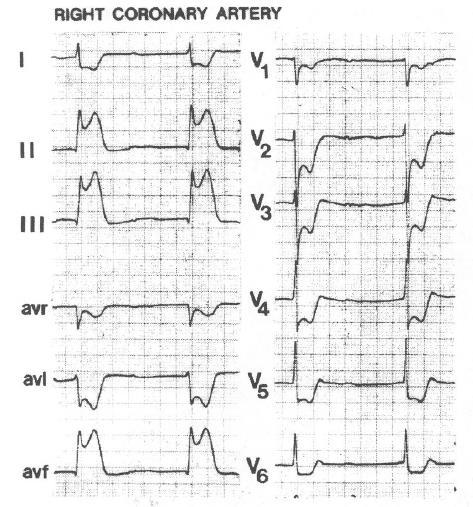 14 Hình 3.11. Điện tâm đồ của một trường hợp tắc động mạch vành phải Đoạn ST chênh lên ở các chuyển đạo dưới với ST chênh lên ở DIII nhiều hơn ở DII. ST chênh xuống ở DI.