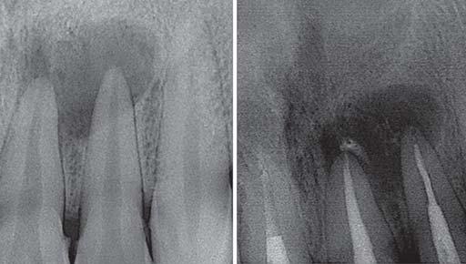 Intraoral periapical radiograph (IOP) of 21, 22 region was made, which revealed a large periradicular radiolucency about 9 to 10 mm in diameter in relation to the apex of 21 and 22 (Fig. 2).