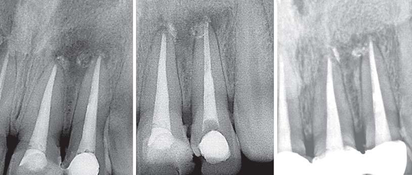 Management of Large Periapical Cystic Lesion by spiration and Nonsurgical Endodontic Therapy canals was ultrasonically flushed out and the dried canal was obturated employing conventional lateral