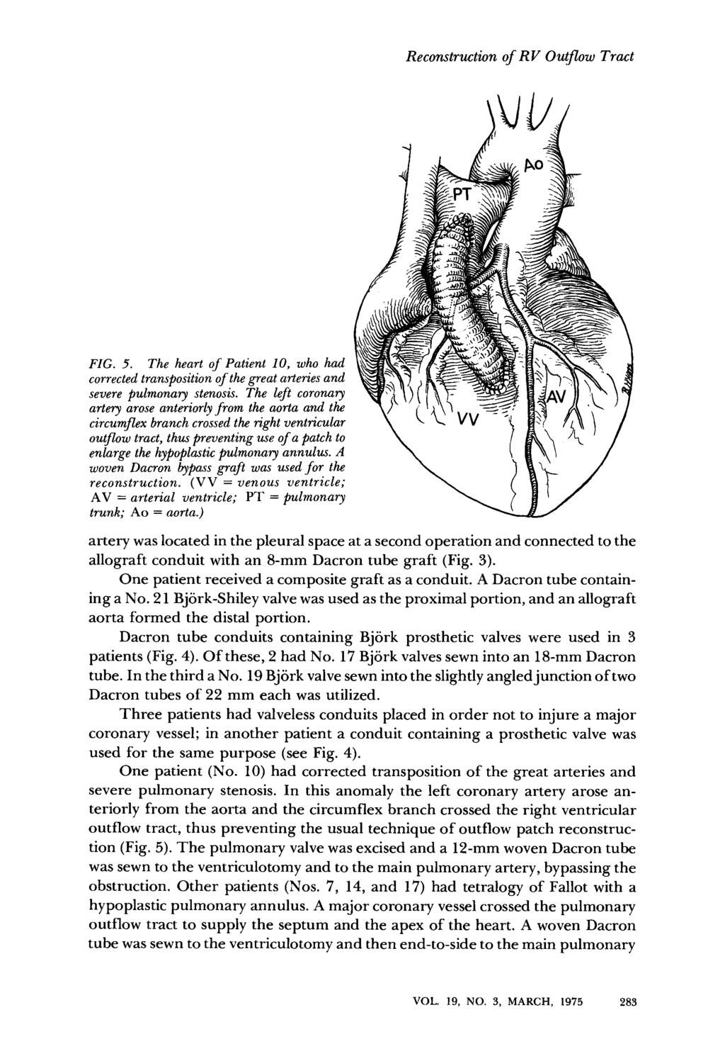 Reconstruction of RV Outflow Tract FIG. 5. The heart of Patient 10, who had corrected transposition of the great arteries and severe pulmonary stenosis.