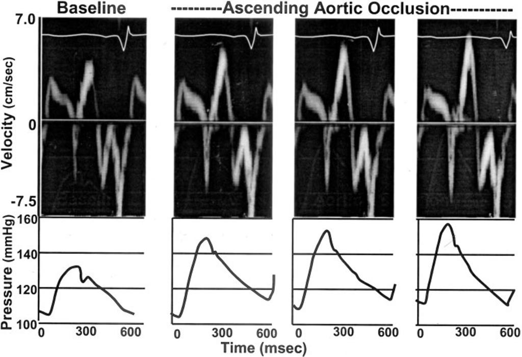Figure 4. Mitral annular pulsed TD velocity recordings (top) and simultaneous LV high-fidelity pressure tracings (bottom) during acute afterload changes induced by partial descending aortic occlusion.
