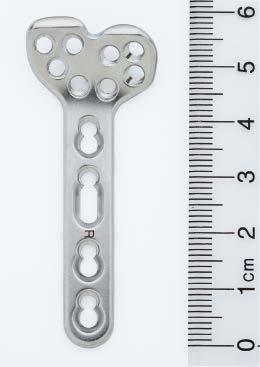 Implants 2.4 mm LCP Volar Column Distal Radius Plates Length Stainless steel* Titanium (mm) Description 02.110.330 04.110.330 50.5 9 hole head, 3 hole shaft, right 02.110.331 04.110.331 50.