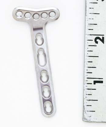 Implants LCP Volar Distal Radius Plates, extra-articular Length Stainless steel* Titanium (mm) Description 242.458 442.