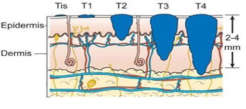 Slika 1. Stupnjevanje melanoma u odnosu na njegovu debljinu (T-stadij bolesti) koja je najznačajniji prognostički čimbenik (3).