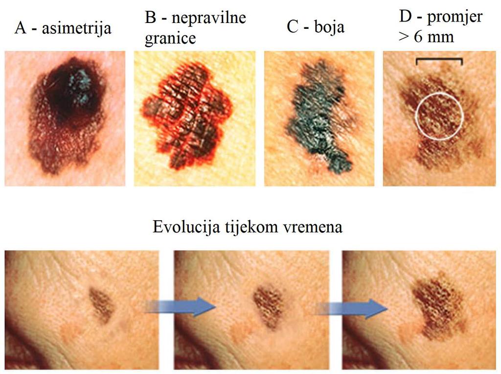 1.3. Dijagnostika Promjene na koži koje bi mogle upućivati na melanom opisuju se kriterijima ABCDE, a odnose se na asimetriju (A od engl. Assimetry), nepravilne granice (B od engl.
