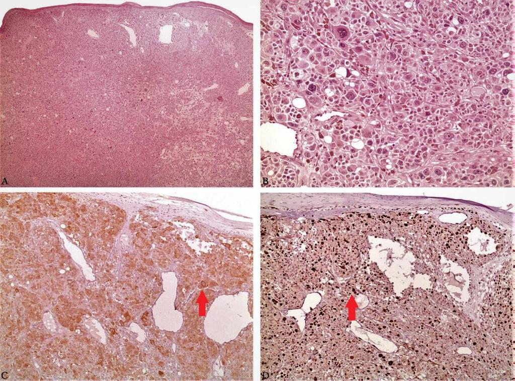Slika 4. Nodularni melanom obojen hemalaun eozinom. Povećanja: A) 4x; B) 40x; C) imunoreaktivnost na protein MART-1 i D) Ki-67. Strjelice upućuju na specifično bojanje antigena (23).