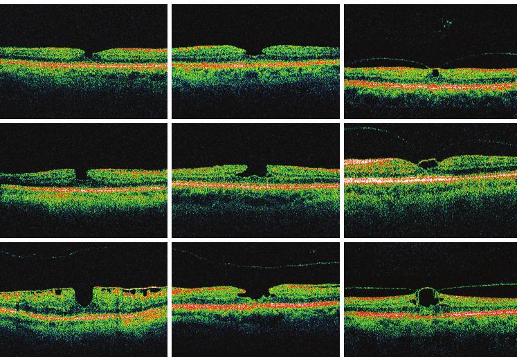 Clinical science Figure 2 (A) Optical coherence tomography (OCT) scan of a sharply punched-out defect corresponding to a macular pseudohole (MPH).