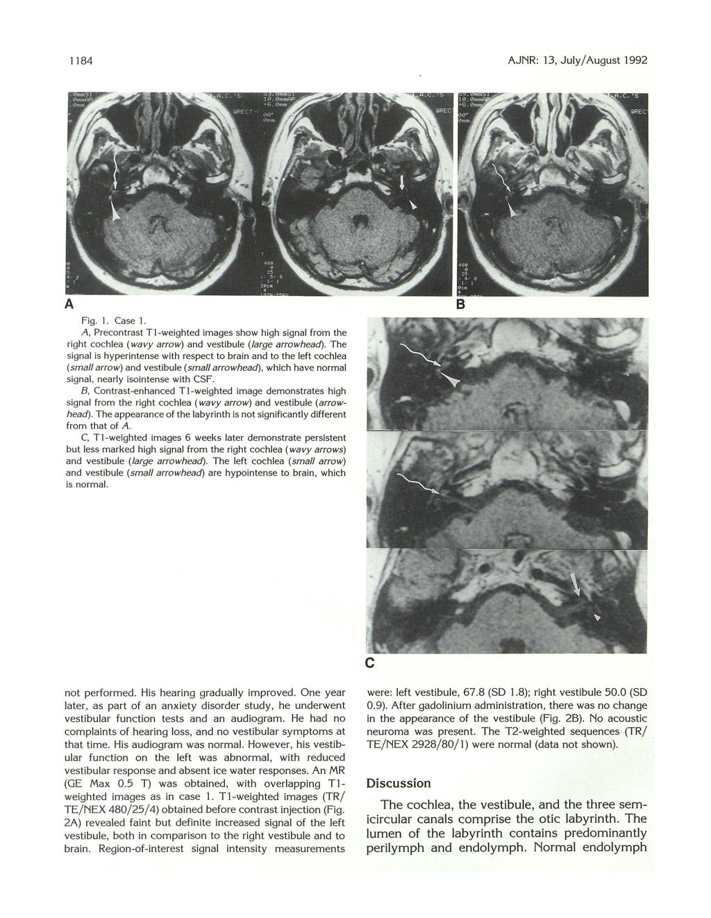 1184 AJNR: 13, July/August 1992 Fig. 1. Case 1. A, Precontrast Tl -weighted images show high signal from the right cochlea (wavy arrow) and vestibule (large arrowhead).