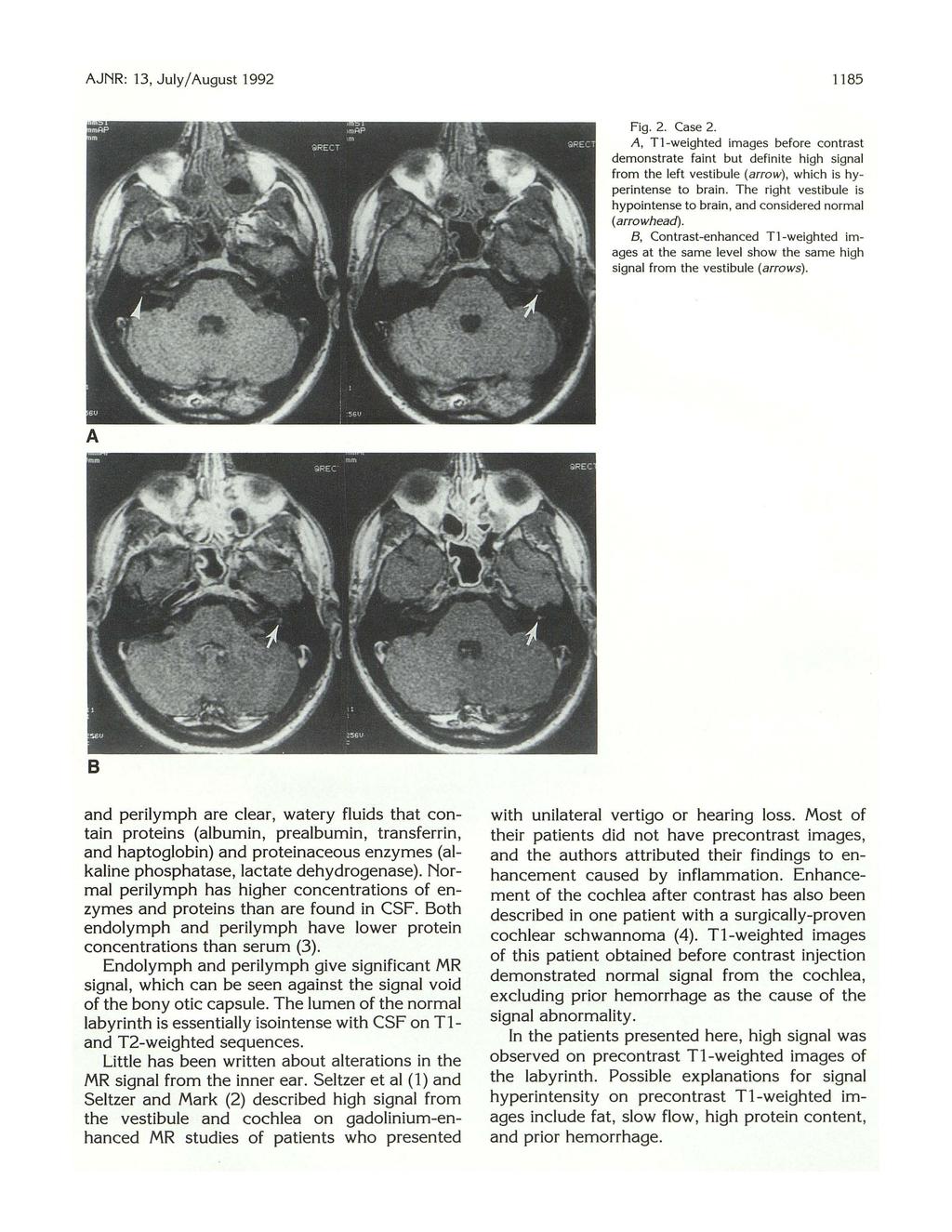 AJNR: 13, July/ August 1992 1185 Fig. 2. Case 2. A, T1-weighted images before contrast demonstrate faint but definite high signal from the left vestibule (arrow), which is hyperintense to brain.