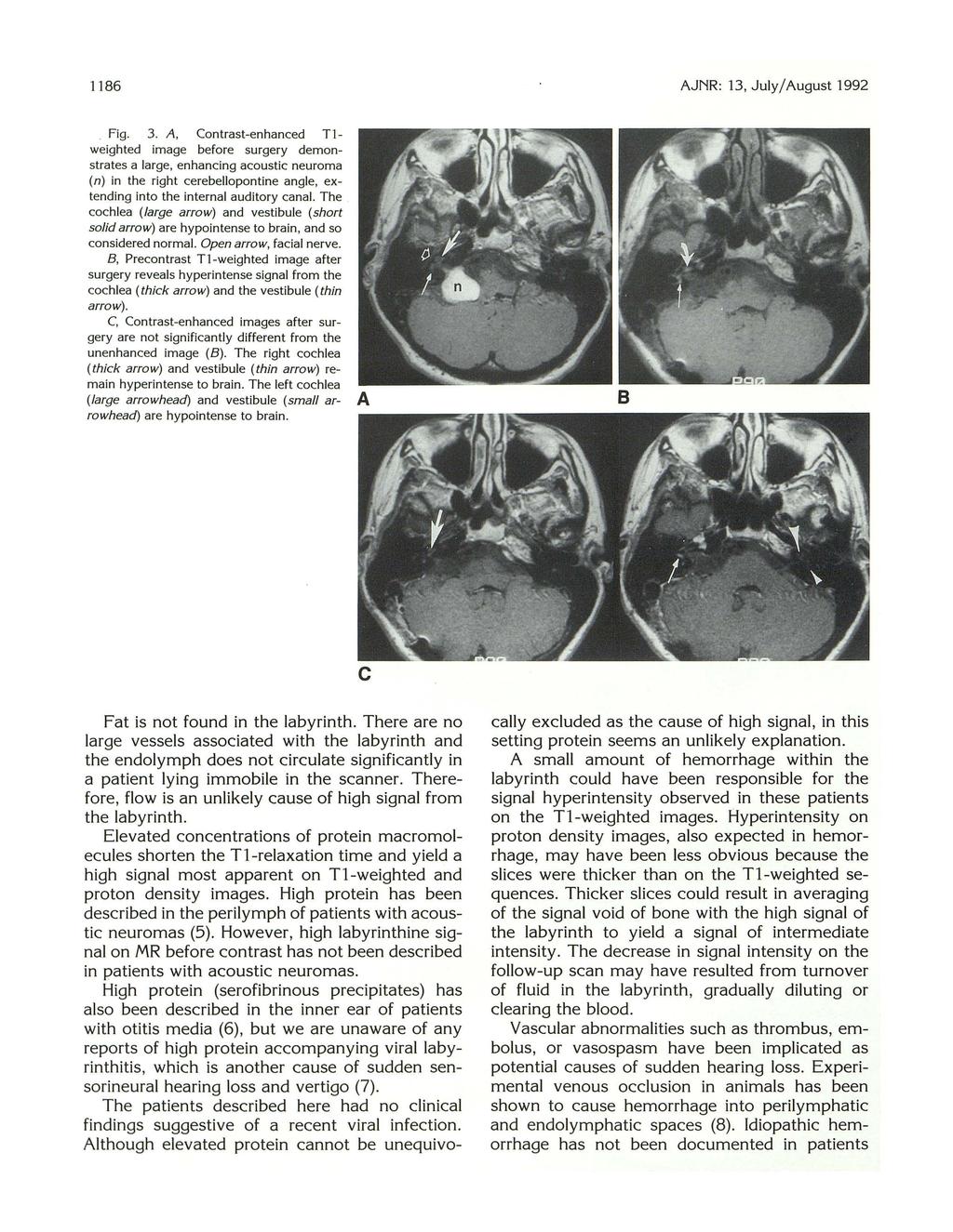 1186 AJNR: 13, July/ August 1992. Fig. 3.