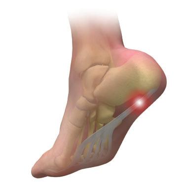 Plantar Fasciitis Heel pain is one of the most common forms of foot pain in adults.