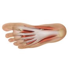 Common treatments for a Plantar Fasciitis Recover technique; Platelet Rich Plasma (PRP) injections Activity restriction Rest Physiotherapy Heel cups/pads Recover PRP treatment