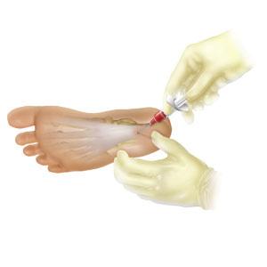 Recover; Natural treatment for a Plantar Fasciitis Recover treatment A 60 ml sample of blood is withdrawn from your arm.