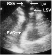 R. N. Khouzam et al.: Echocardiography of the SVC 363 FIG.1 Two-dimensional imaging of the normal superior vena cava (SVC) from the right supraclavicular window.