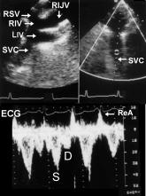The proximal (lower) part of the SVC is better defined in the subcostal view; the distal (upper) half of the SVC is more clearly seen in the right supraclavicular or suprasternal view.