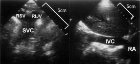 364 Clin. Cardiol. Vol. 28, August 2005 (A) FIG. 4 (A) Right suprasternal view showing dilatation of the superior vena cava (SVC) in a patient with congestive heart failure.