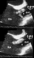 R. N. Khouzam et al.: Echocardiography of the SVC 365 SVC syndrome requires the use of an imaging study to document the obstruction and presence of collateral venous channels.