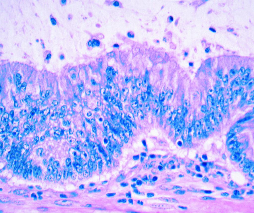 Halvarsson et al / MORPHOLOGY IN MMR-DEFECTIVE COLON CANCER A B C D Image 1 Tumor morphologic features that best determined mismatch repair (MMR) status in colon cancer.