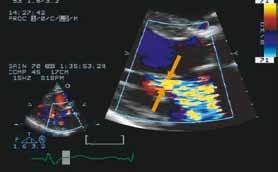 sector to view part of IVS, aortic valve, and mitral leaflets n Show coaptation of both leaflets clearly 1 n M-mode of LV perpendicular and just below
