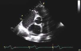 Parasternal Short Axis Views to Obtain Aortic Valve Level n 2D optimizing pulmonary valve annulus n PW Doppler