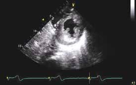 capture image with and without color n Measure mitral valve area at leaflet tips n Measure flail width