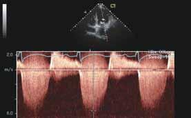 endocardial border delineation is <80%, contrast is recommended at end of study Spectral Doppler n CW Doppler of MR jet n CW Doppler of mitral inflow n PW Doppler of