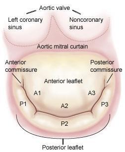 abnormality the mitral valve Leaflets Subvalvular apparatus Chordae and papillary muscles Secondary : LV