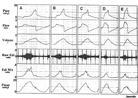Hess RC 2005:50:166 Yoshida, Amato, Fujino AJRCCM In Press Pleural pressure monitoring, non - dependent, dependent and esophageal Dynamic CT, EIT volume distribution