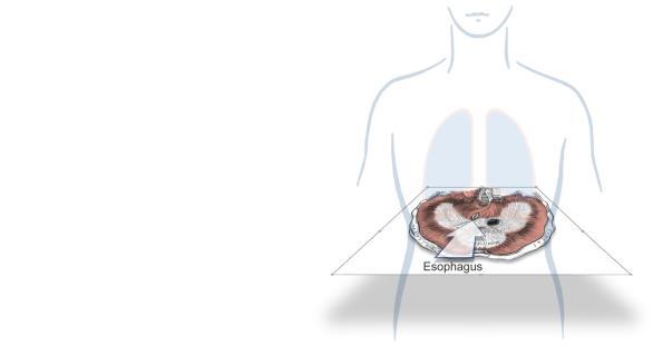 Catheter for measuring electrical activity of the diaphragm (EAdi or Edi) NAVA