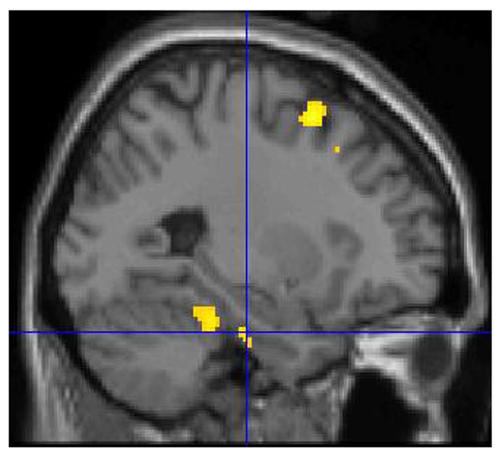 The left parahippocampal gyrus activation revealed by the contrast R vs K was displayed on a sagittal brain section.