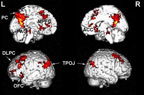 Experimental work Figure 10. Significantly activated areas for the comparison autobiographical condition vs control condition are shown on a 3-D rendered standard MRI (one-sample t test; p < 0.