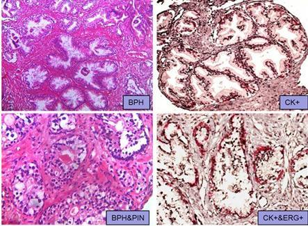 Table 1: Comparison of Histopathological Diagnosis and Final Diagnosis after ERG and p63 immunohistochemical evaluation Histopathological diagnosis Final Diagnosis BPH (n=12) PIN (n=7) Ca Prostate