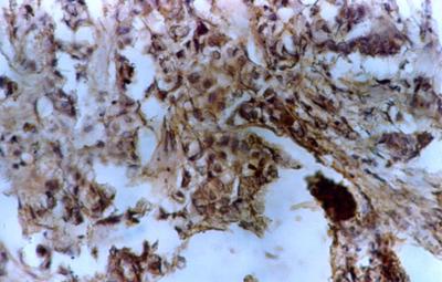 carcinoma breast. Using immunohistochemical and biochemical methods, several studies have shown a worse prognosis for those patients with tumors with high angiogenic activity.