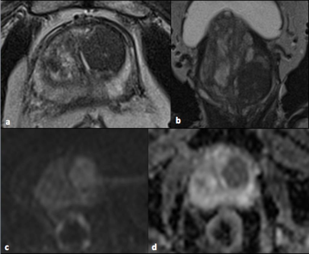 Fig. 9: T2-weighted axial (a) and coronal (b) images show a nodular area of hypointense signal in the left transitional zone.