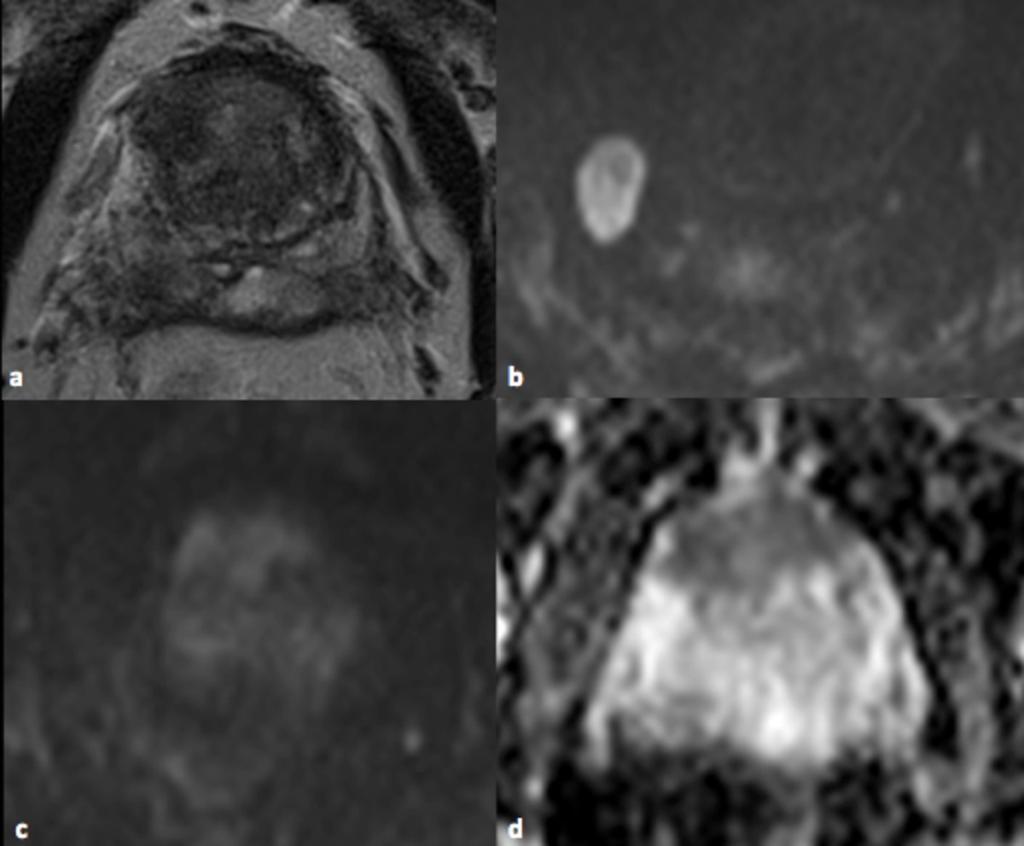 Fig. 10: A 62-year-old man with Gleason 8 (4+4) PCa involving the TZ and the anterior fibromuscular stroma at prostatic base.